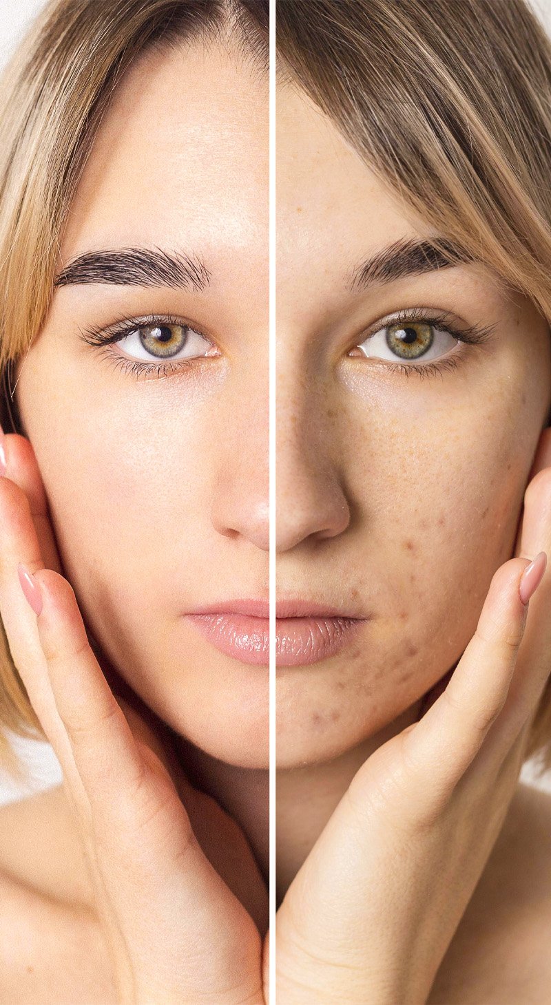Collagen  Induction Therapy Microneedling
