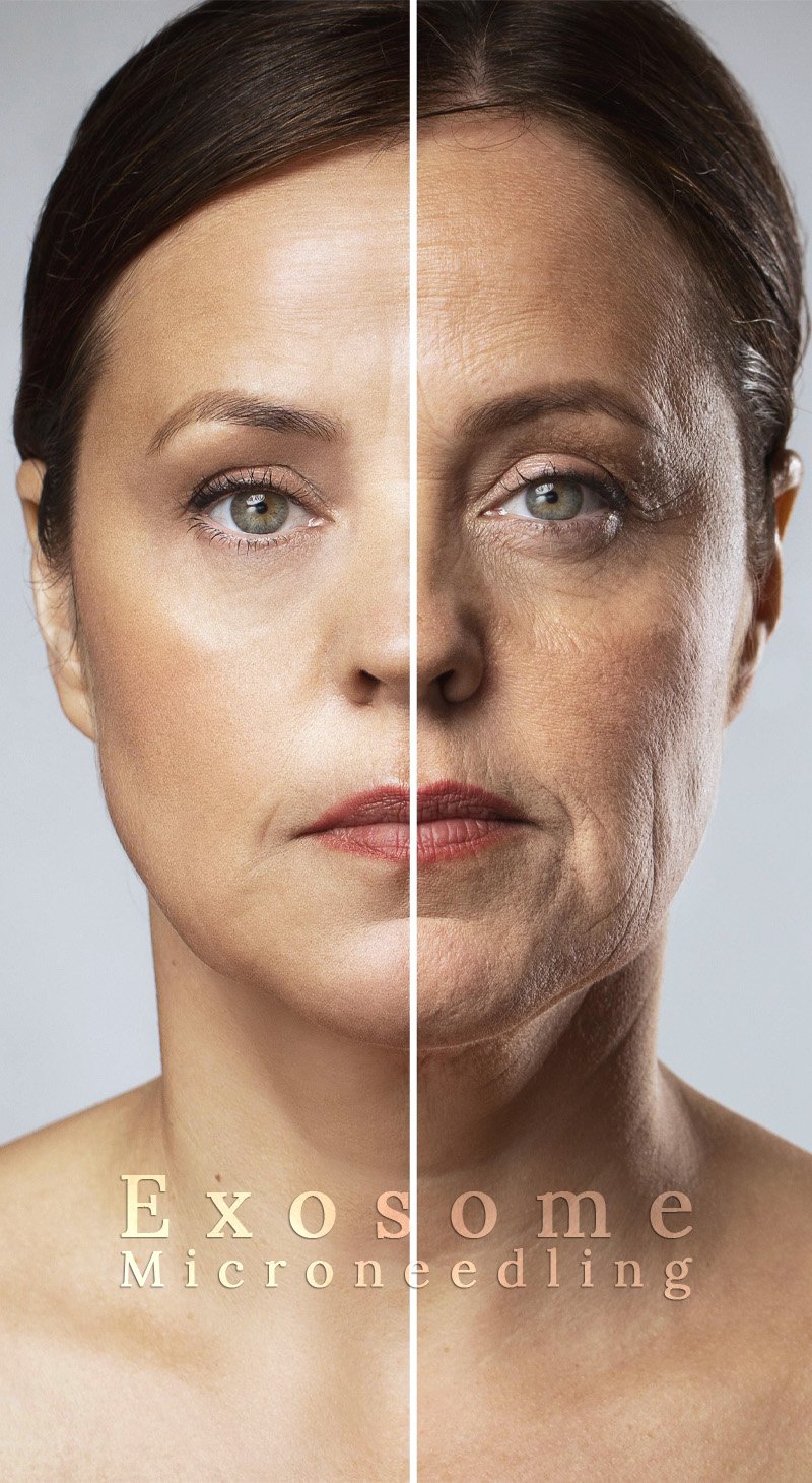 Exosomes Microneedling