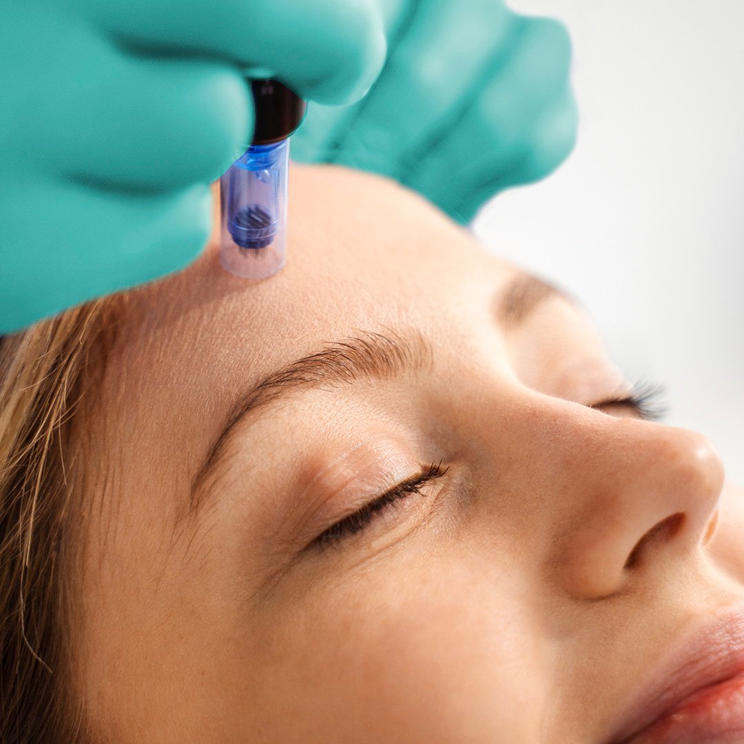 Collagen Induction Therapy Microneedling Collagen Induction Therapy Microneedling