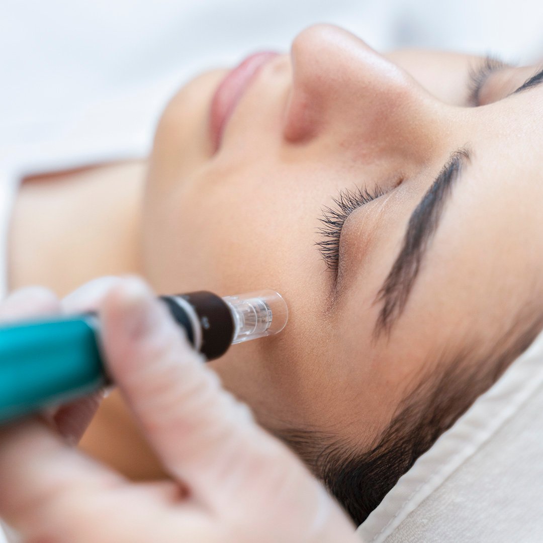 Collagen Induction Therapy Microneedling Collagen Induction Therapy Microneedling