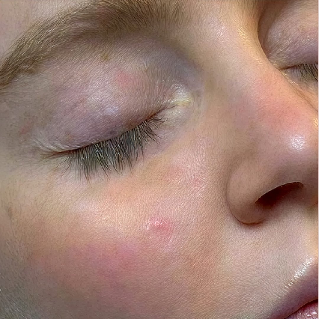 Hydra Facial