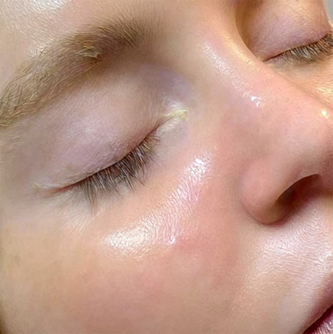 Hydra Facial